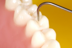 Le sucre de xylitol reminéralise les dents